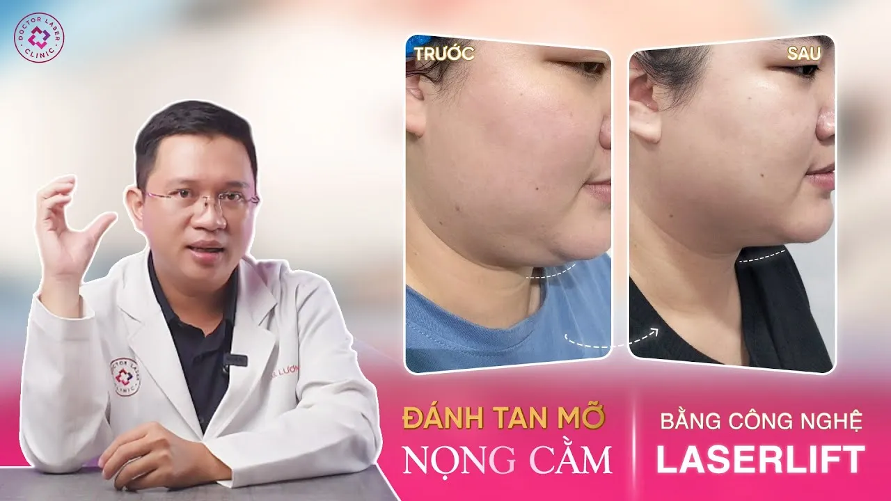 Đánh tan mỡ nọng cầm bằng phương pháp Laser lift 